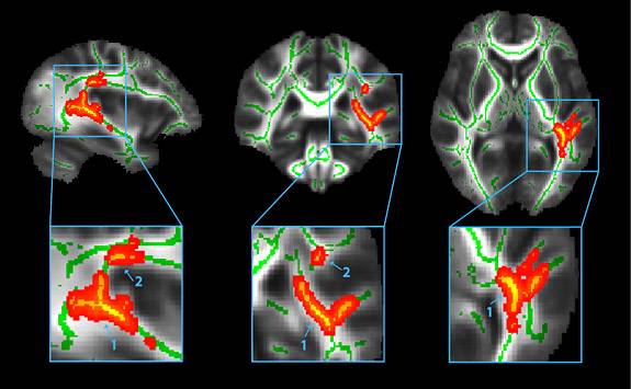 Concussion brainscan