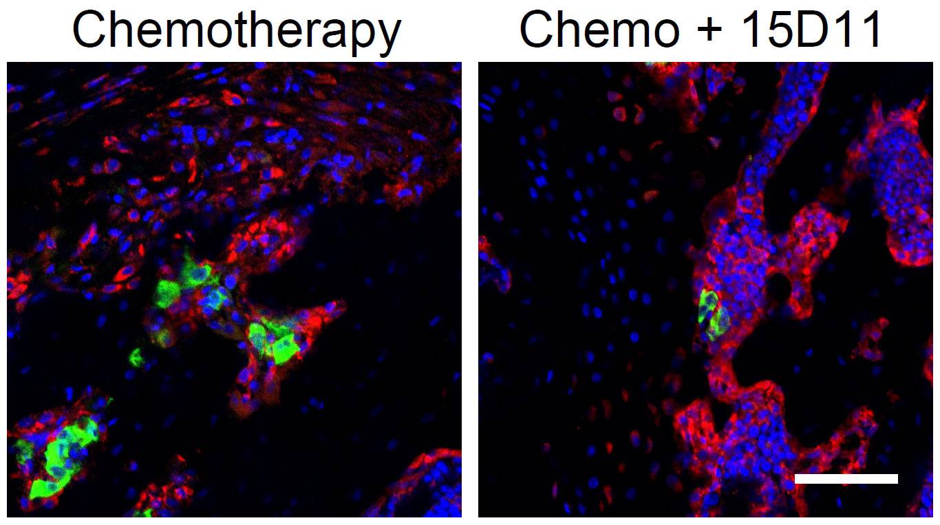 Bone metastases treated by chemotherapy on left and antibody on right